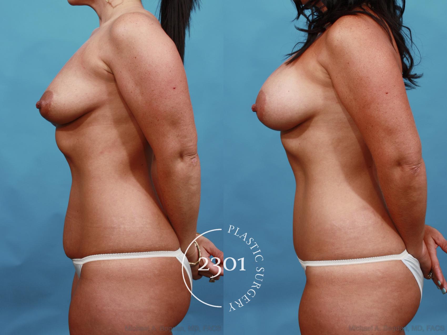 Before & After Tummy Tuck Case 505 View #3 View in Fort Worth, Plano, & Frisco, Texas