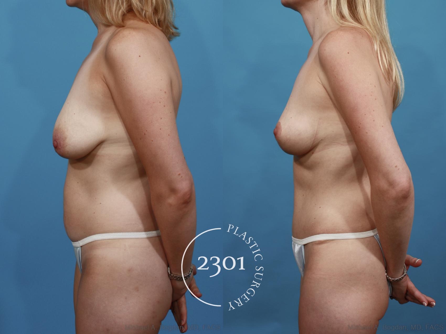 Before & After Mommy Makeover Case 506 View #3 View in Fort Worth, Plano, & Frisco, Texas