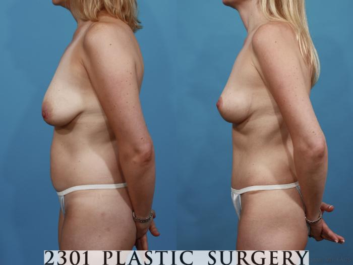 Before & After Mommy Makeover Case 506 View #3 View in Fort Worth, Plano, & Frisco, Texas