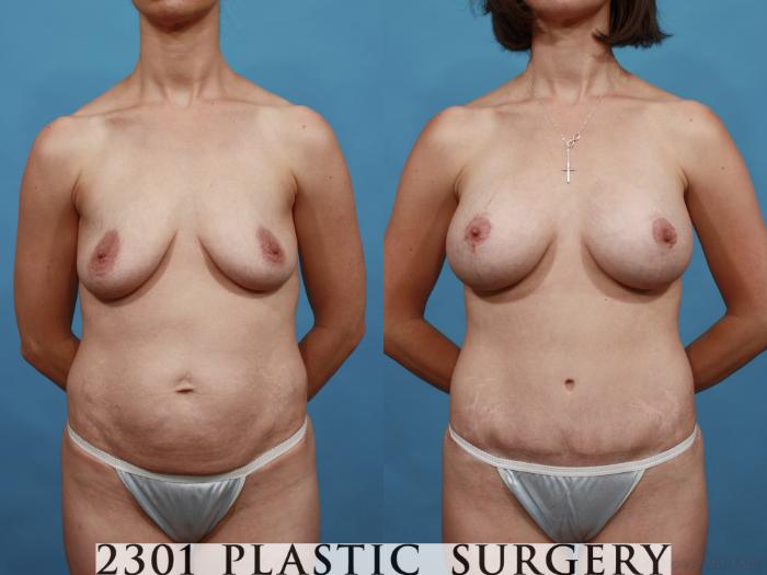 Before & After Tummy Tuck Case 509 View #1 View in Fort Worth, Plano, & Frisco, Texas