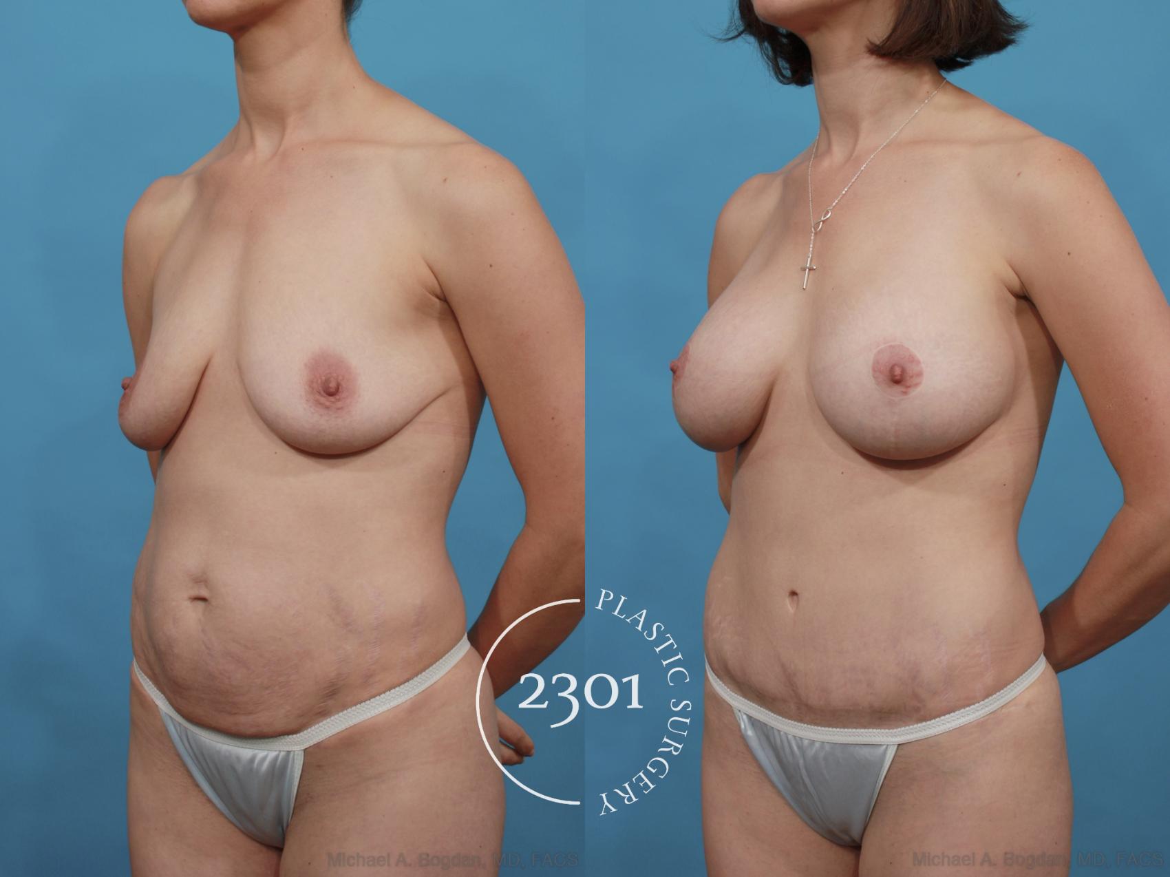 Before & After Mommy Makeover Case 509 View #2 View in Fort Worth, Plano, & Frisco, Texas