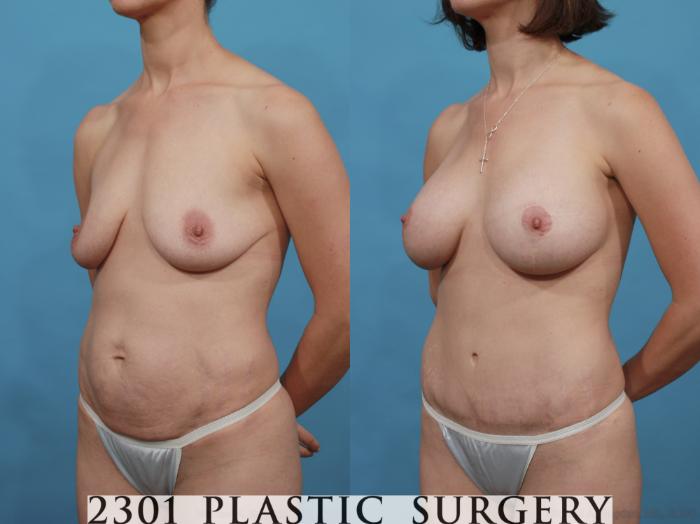 Before & After Tummy Tuck Case 509 View #2 View in Fort Worth, Plano, & Frisco, Texas