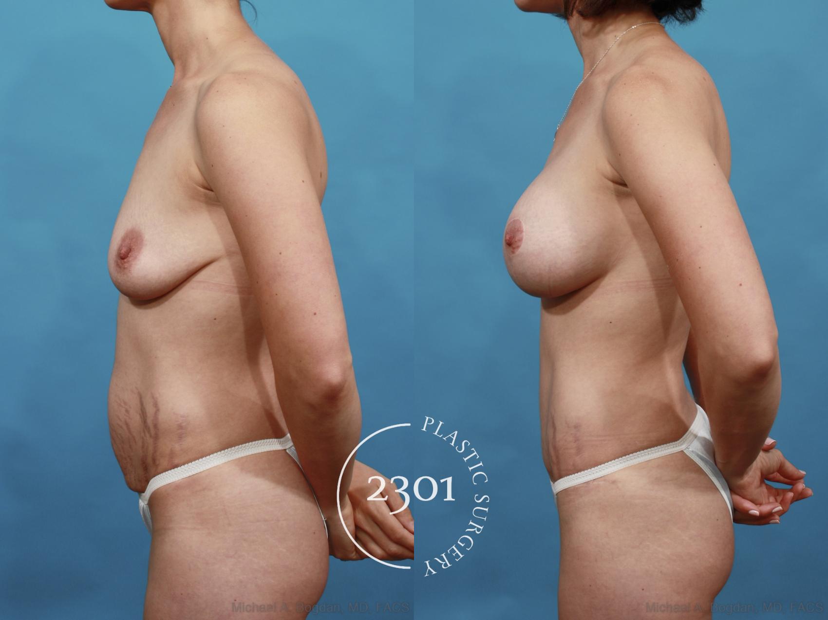 Before & After Mommy Makeover Case 509 View #3 View in Fort Worth, Plano, & Frisco, Texas