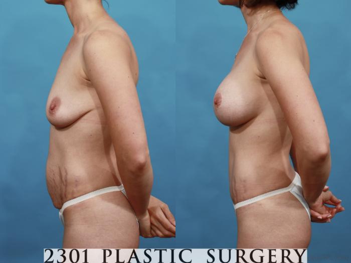 Before & After Tummy Tuck Case 509 View #3 View in Fort Worth, Plano, & Frisco, Texas