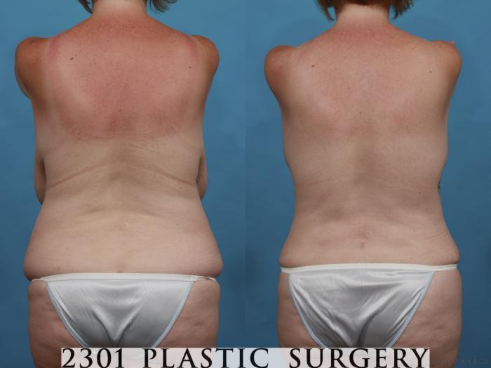 Before & After Mommy Makeover Case 516 View #5 View in Fort Worth, Plano, & Frisco, Texas