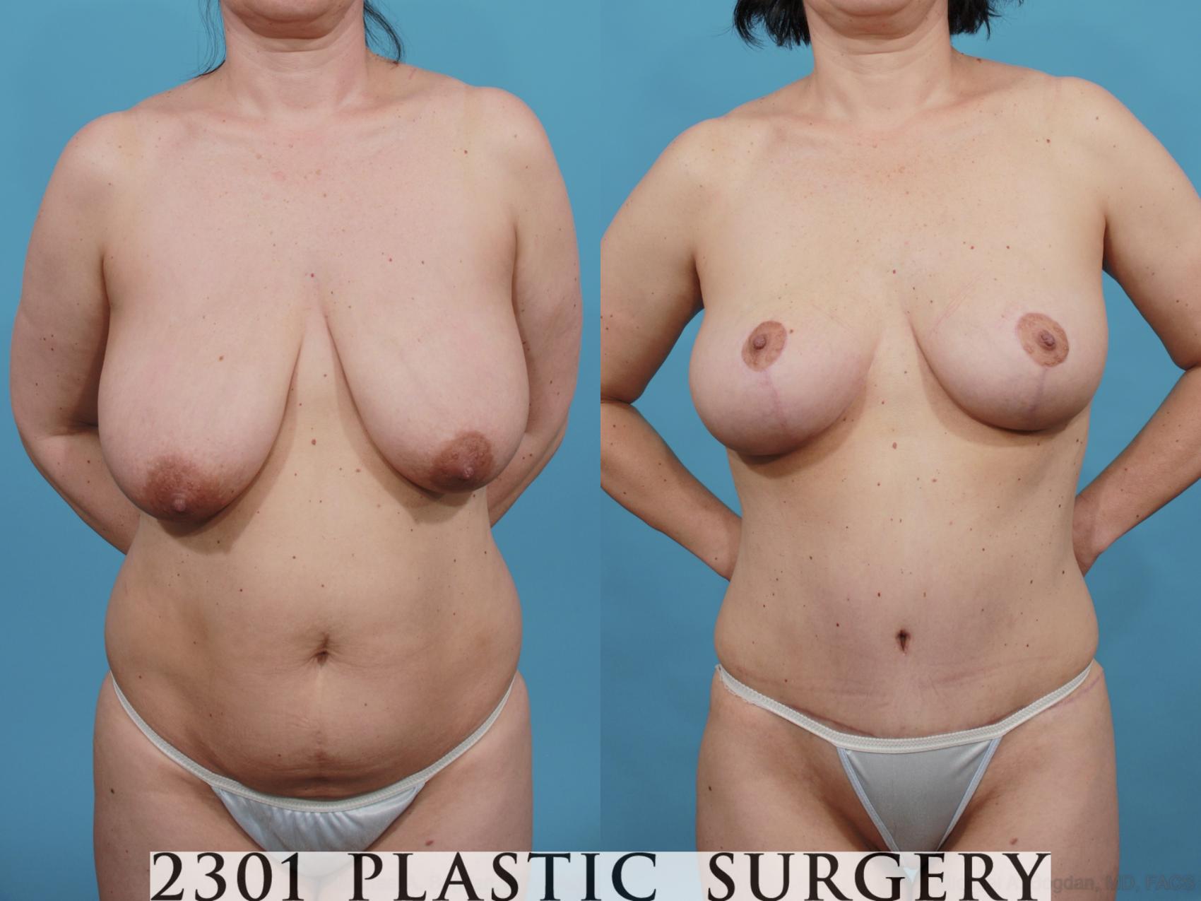 Before & After Breast Lift (Mastopexy) Case 518 View #1 View in Fort Worth & Frisco, Texas