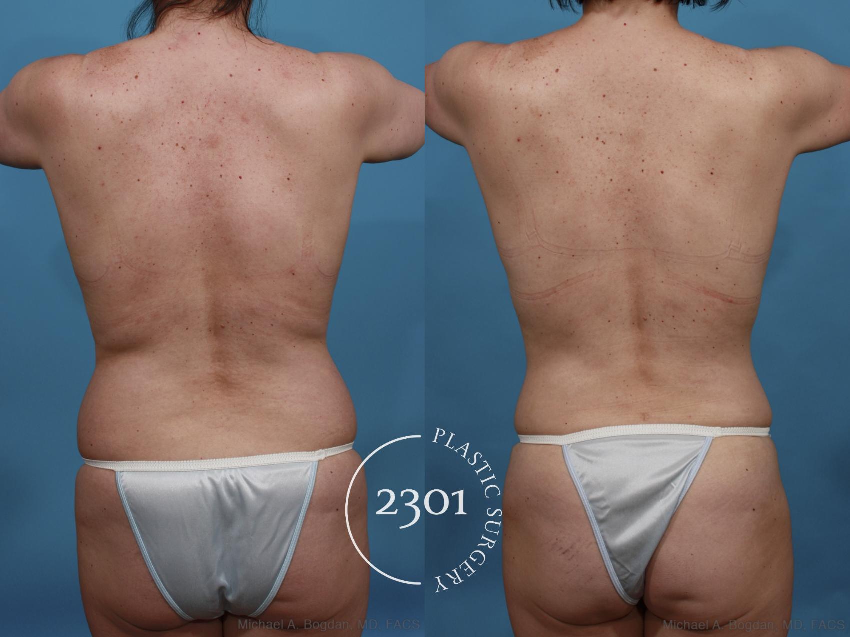 Before & After Mommy Makeover Case 518 View #5 View in Fort Worth & Frisco, Texas