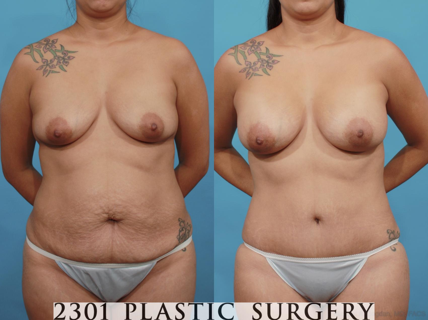 Before & After Tummy Tuck Case 527 View #1 View in Fort Worth, Plano, & Frisco, Texas