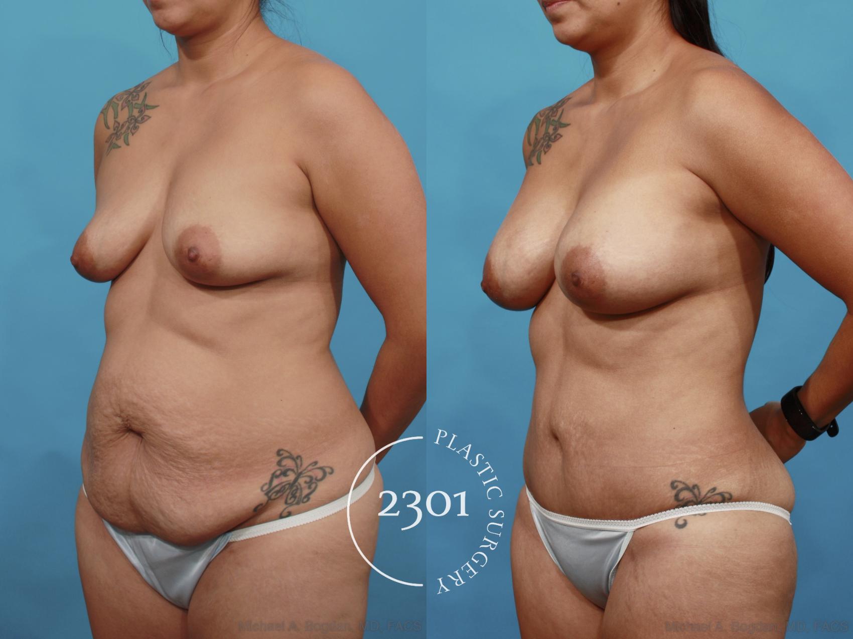 Before & After Liposuction Case 527 View #2 View in Fort Worth, Plano, & Frisco, Texas