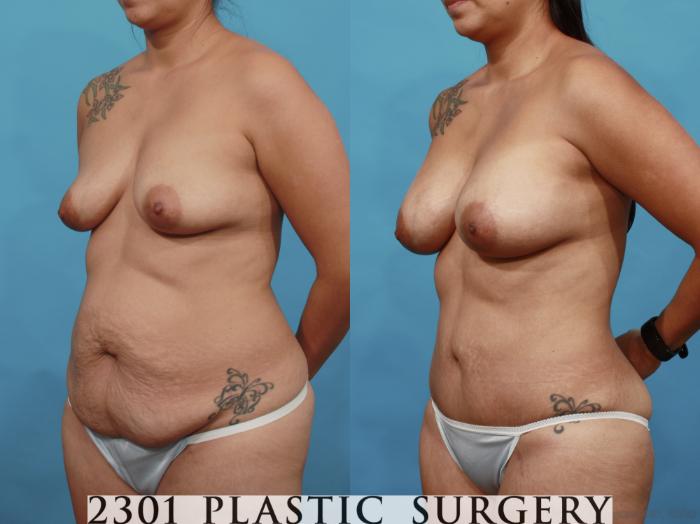 Before & After Silicone Implants Case 527 View #2 View in Fort Worth, Plano, & Frisco, Texas