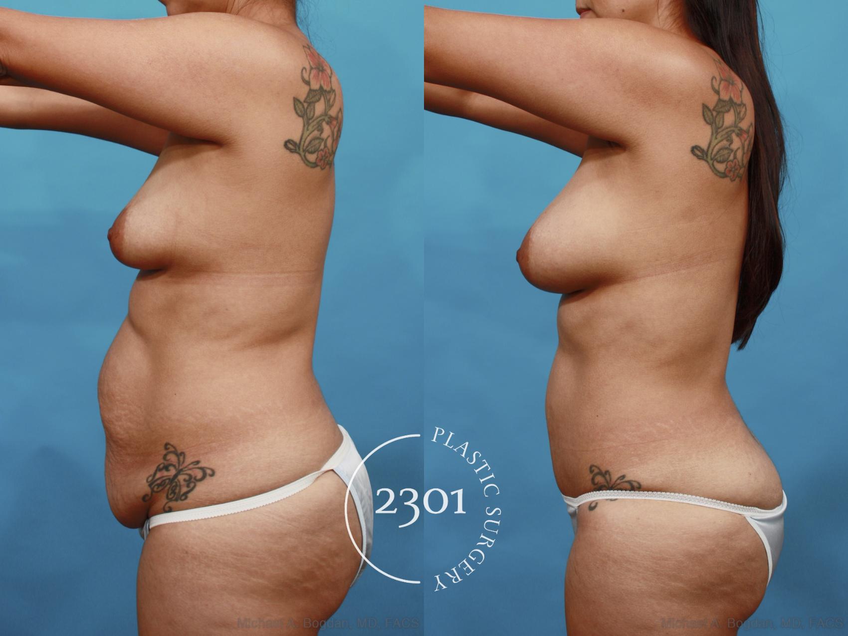 Before & After Liposuction Case 527 View #3 View in Fort Worth, Plano, & Frisco, Texas