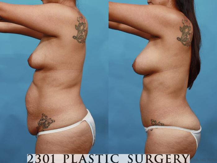 Before & After Mommy Makeover Case 527 View #3 View in Fort Worth, Plano, & Frisco, Texas
