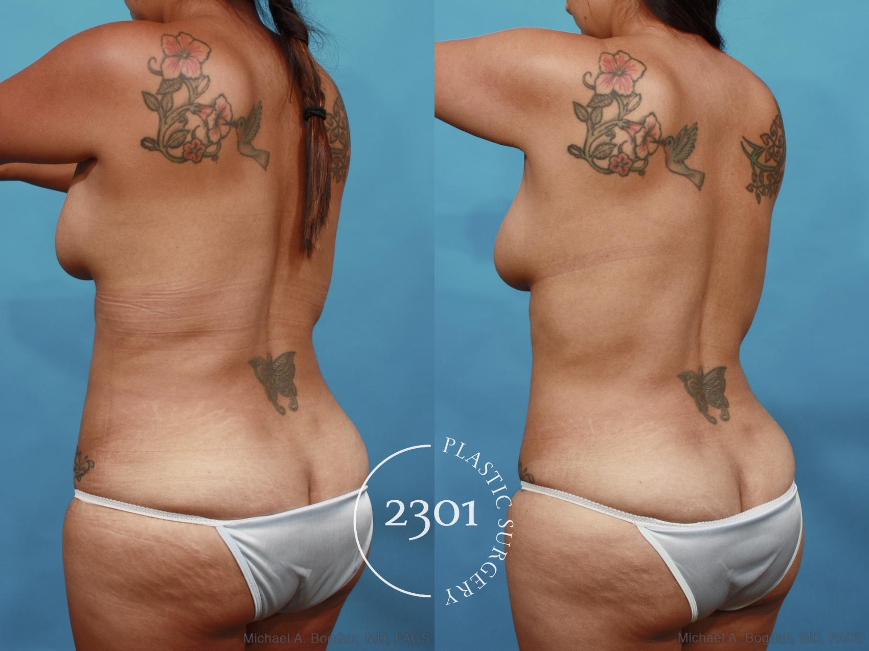 Before & After Liposuction Case 527 View #4 View in Fort Worth, Plano, & Frisco, Texas