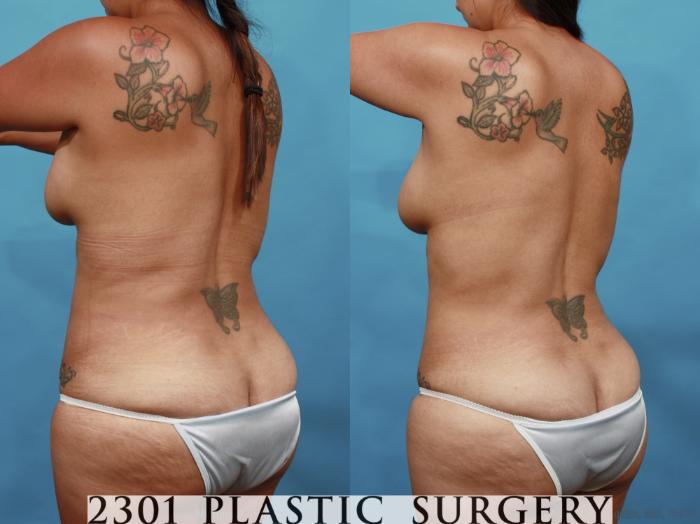 Before & After Liposuction Case 527 View #4 View in Fort Worth, Plano, & Frisco, Texas