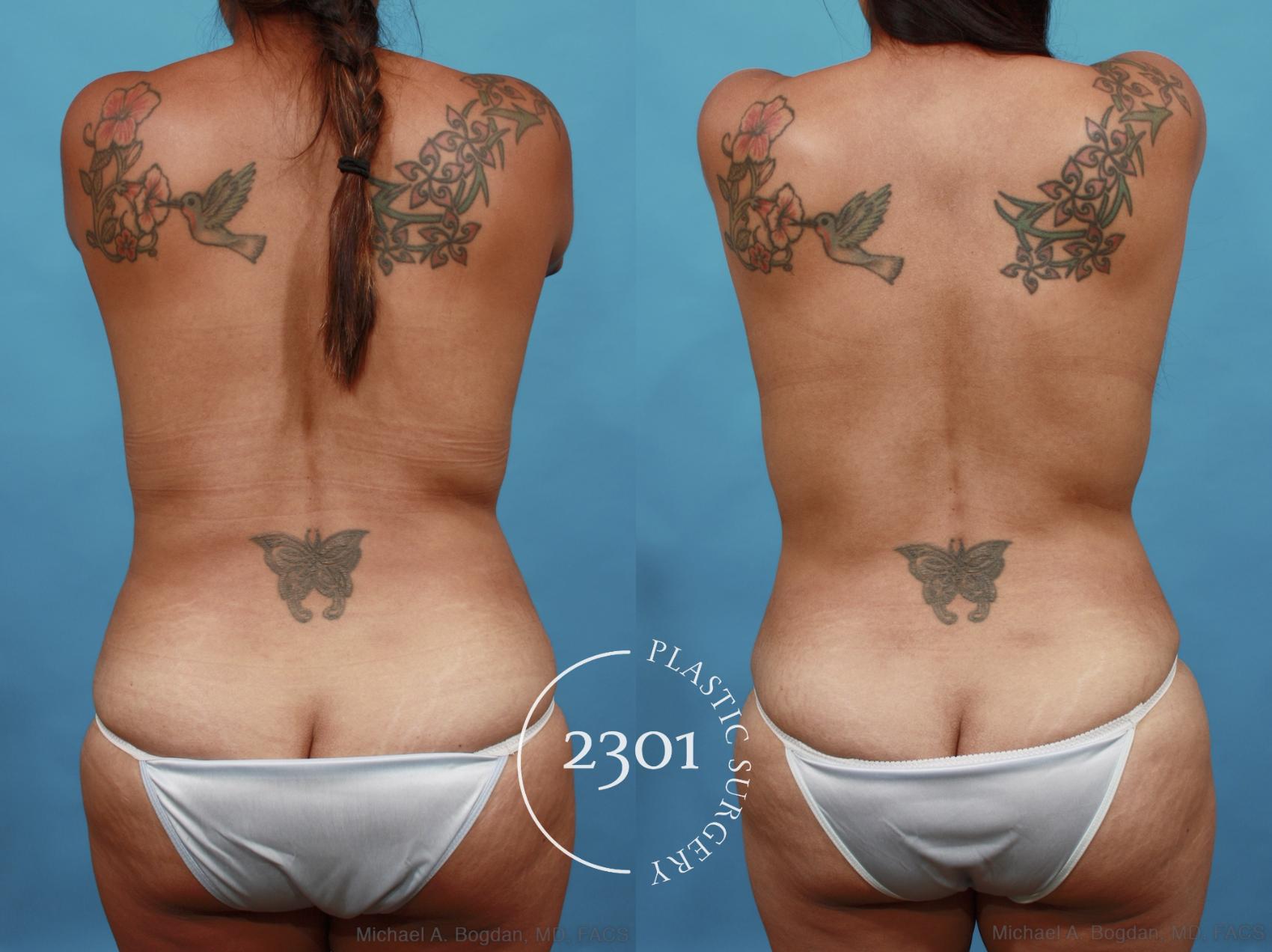 Before & After Liposuction Case 527 View #5 View in Fort Worth, Plano, & Frisco, Texas