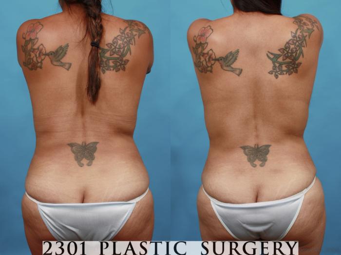 Before & After Silicone Implants Case 527 View #5 View in Fort Worth, Plano, & Frisco, Texas