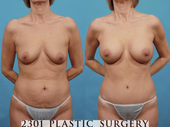 Before & After Breast Augmentation Case 528 View #1 View in Fort Worth, Plano, & Frisco, Texas