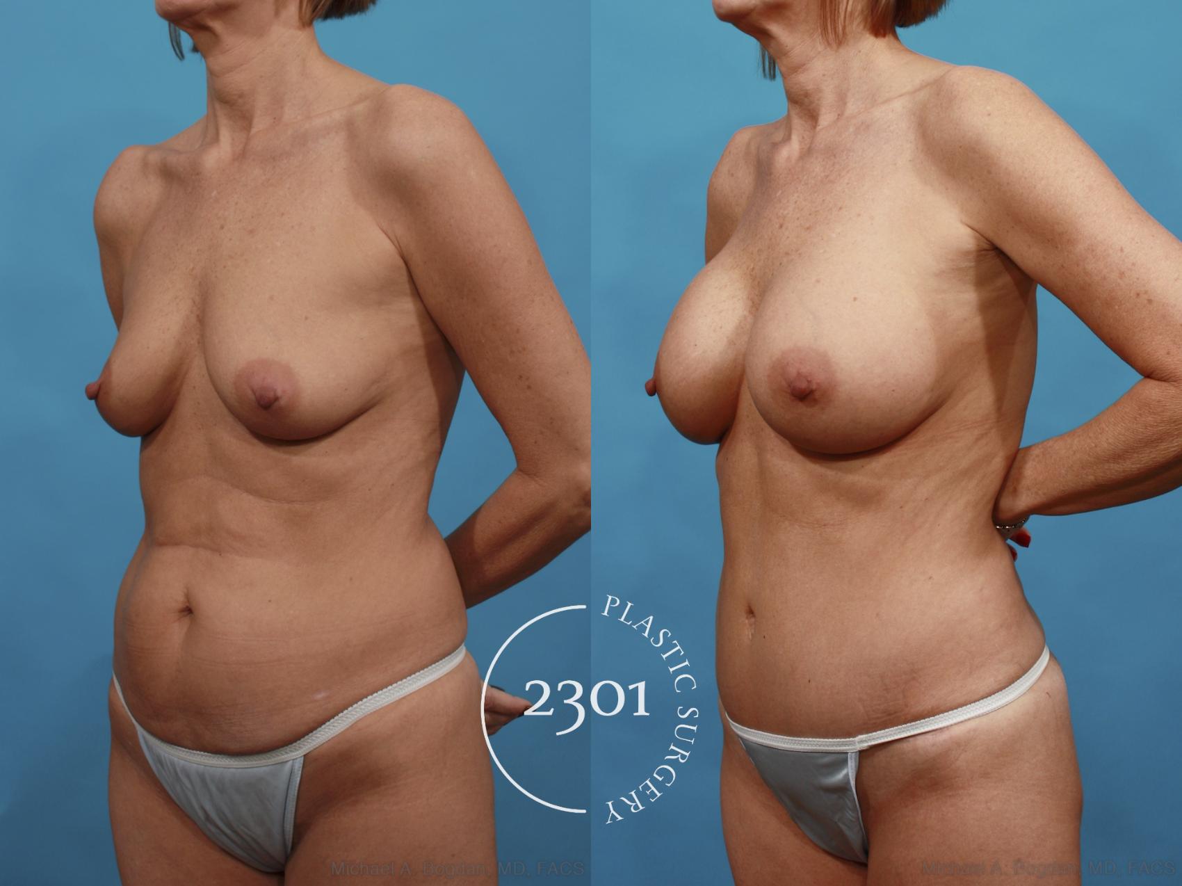 Before & After Silicone Implants Case 528 View #2 View in Fort Worth, Plano, & Frisco, Texas