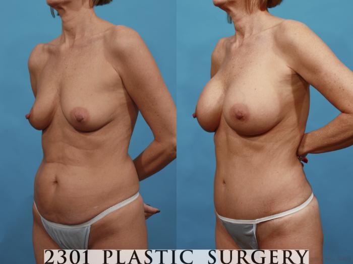 Before & After Tummy Tuck Case 528 View #2 View in Fort Worth, Plano, & Frisco, Texas
