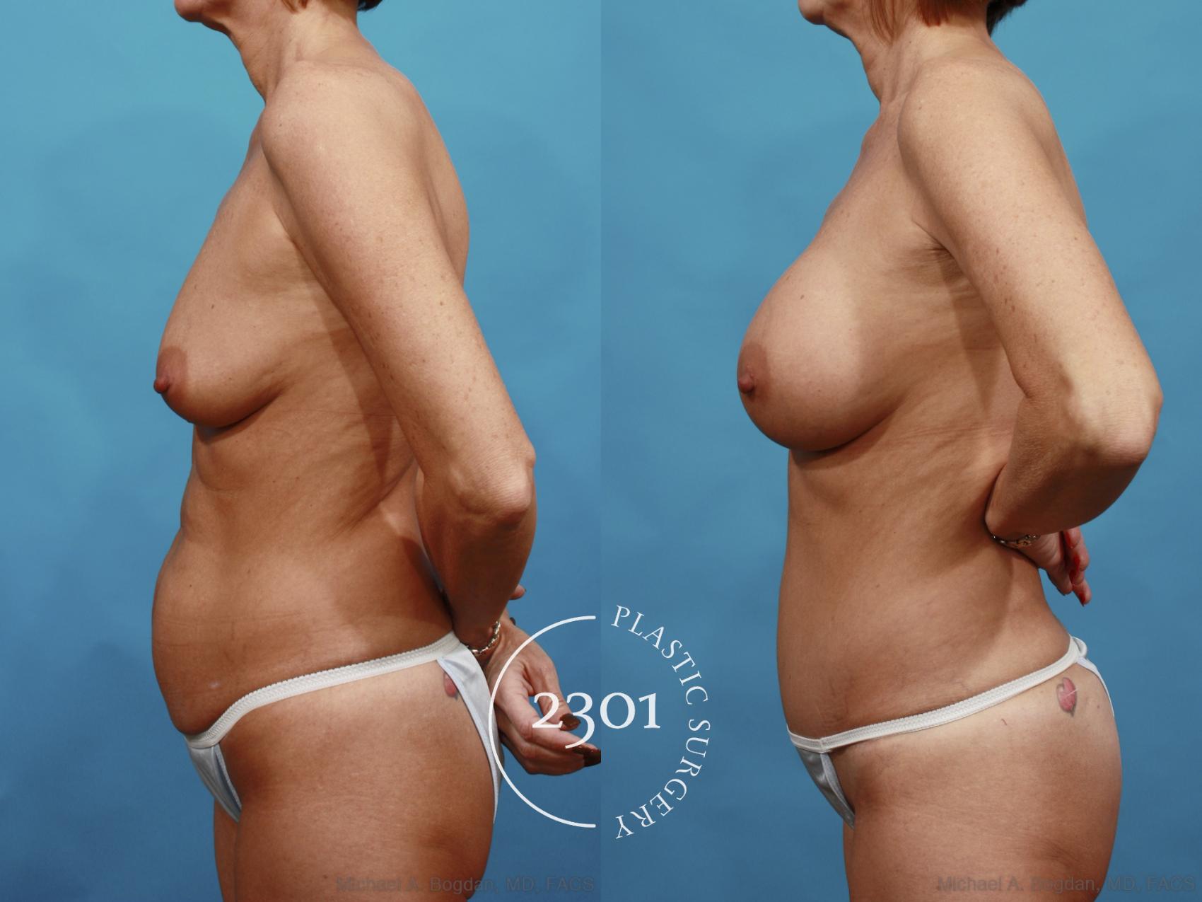 Before & After Silicone Implants Case 528 View #3 View in Fort Worth, Plano, & Frisco, Texas