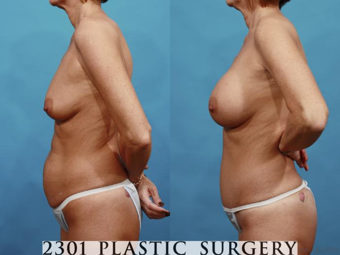 Before & After Silicone Implants Case 528 View #3 View in Fort Worth, Plano, & Frisco, Texas