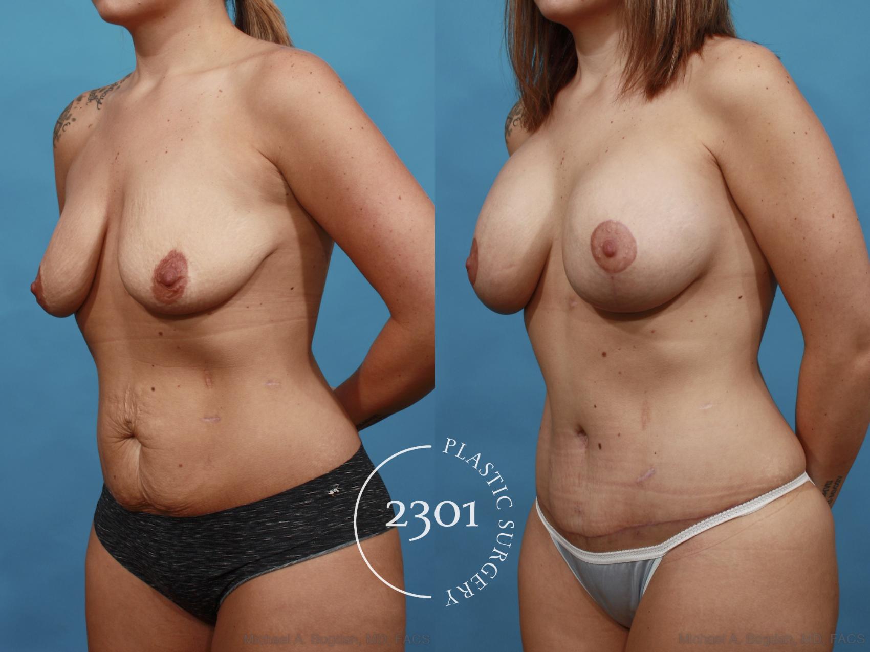 Before & After Mommy Makeover Case 531 View #2 View in Fort Worth, Plano, & Frisco, Texas