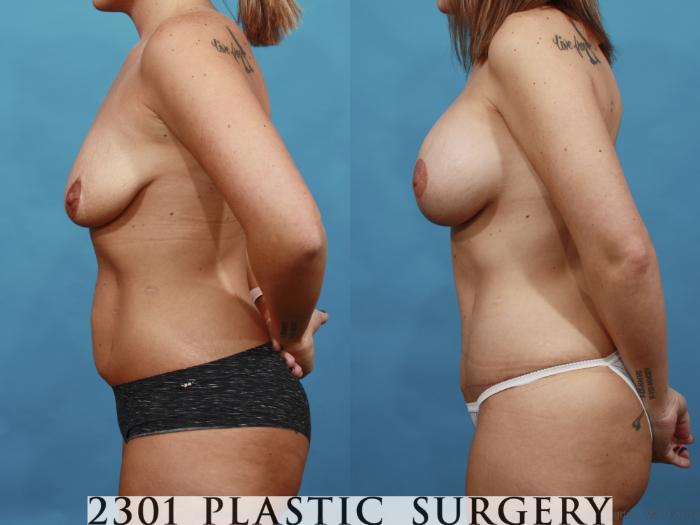 Before & After Mommy Makeover Case 531 View #3 View in Fort Worth, Plano, & Frisco, Texas