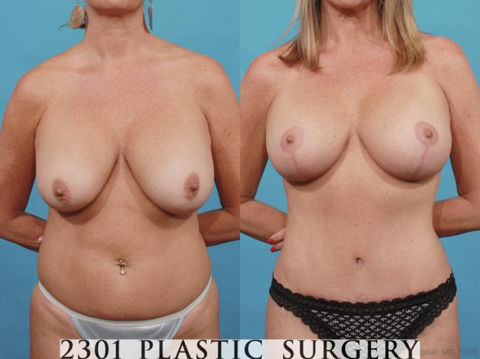 Before & After Breast Lift (Mastopexy) Case 540 View #1 View in Fort Worth, Plano, & Frisco, Texas