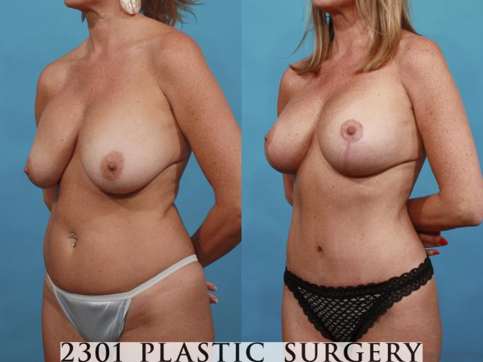 Before & After Breast Lift (Mastopexy) Case 540 View #2 View in Fort Worth, Plano, & Frisco, Texas