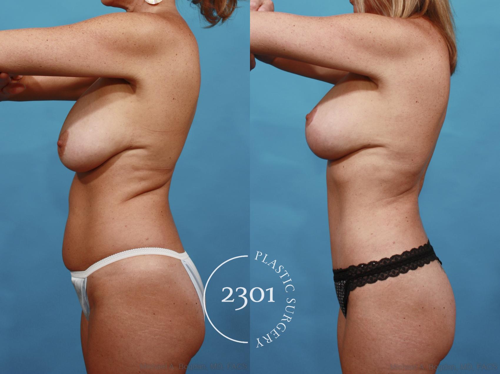Before & After Tummy Tuck Case 540 View #3 View in Fort Worth, Plano, & Frisco, Texas