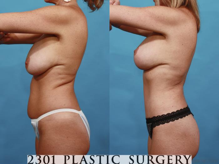 Before & After Breast Lift (Mastopexy) Case 540 View #3 View in Fort Worth, Plano, & Frisco, Texas