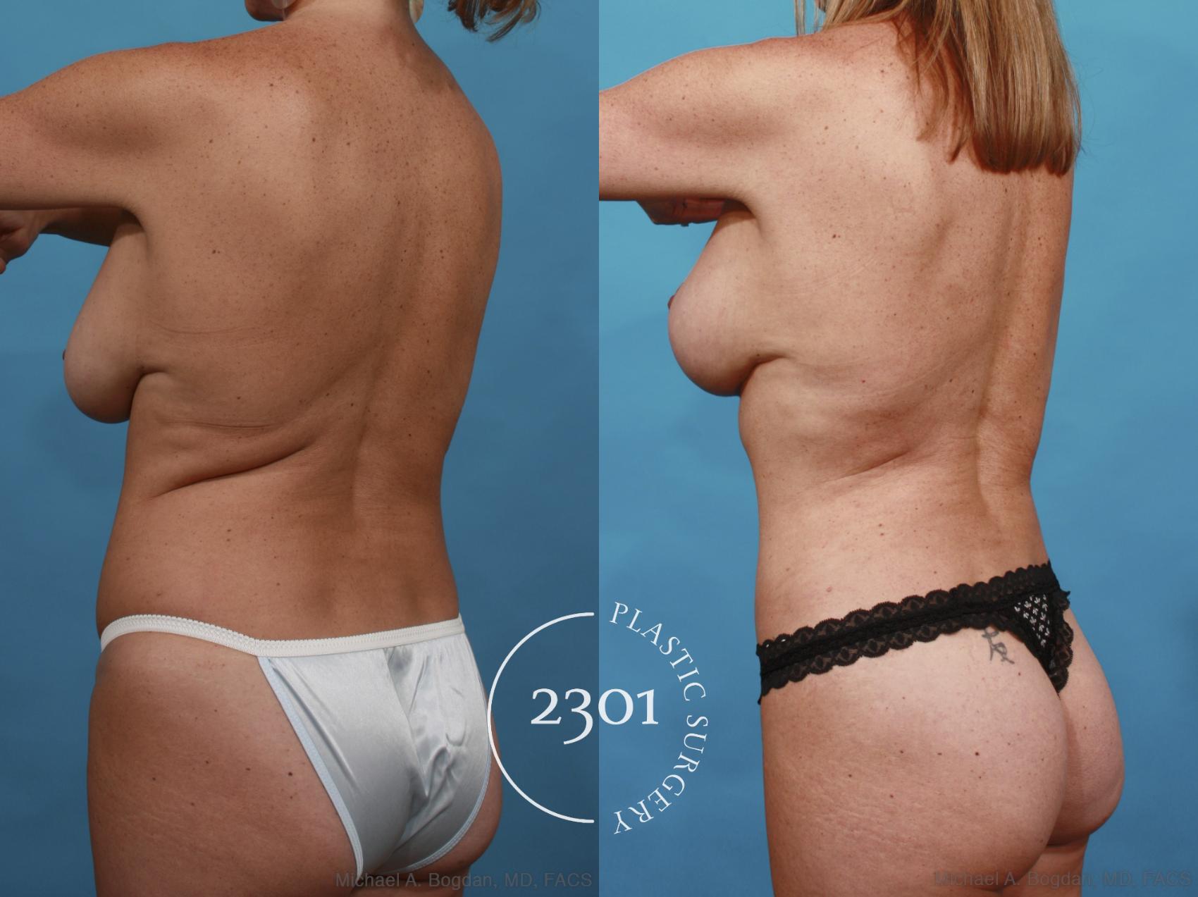 Before & After Tummy Tuck Case 540 View #4 View in Fort Worth, Plano, & Frisco, Texas