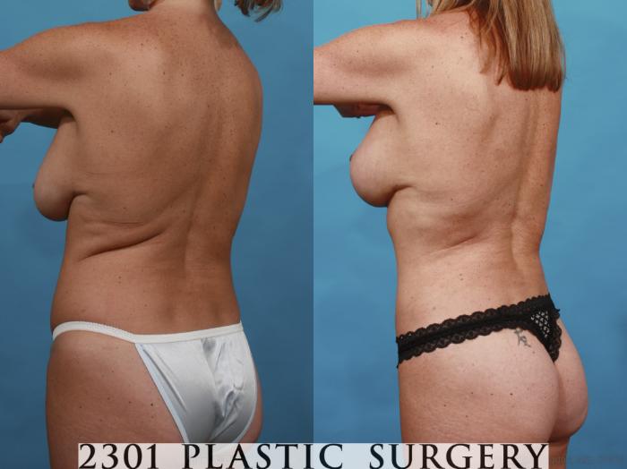 Before & After Breast Lift (Mastopexy) Case 540 View #4 View in Fort Worth, Plano, & Frisco, Texas