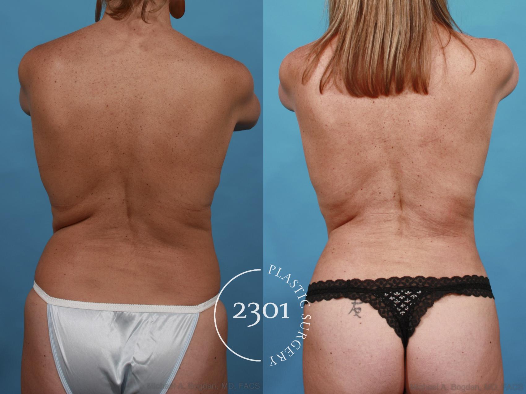 Before & After Tummy Tuck Case 540 View #5 View in Fort Worth, Plano, & Frisco, Texas