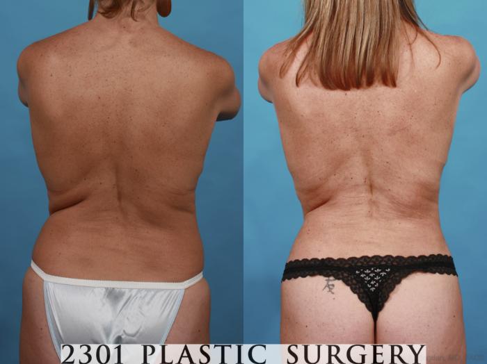 Before & After Breast Lift (Mastopexy) Case 540 View #5 View in Fort Worth, Plano, & Frisco, Texas