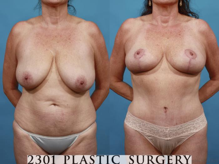 Before & After Tummy Tuck Case 542 View #1 View in Fort Worth, Plano, & Frisco, Texas