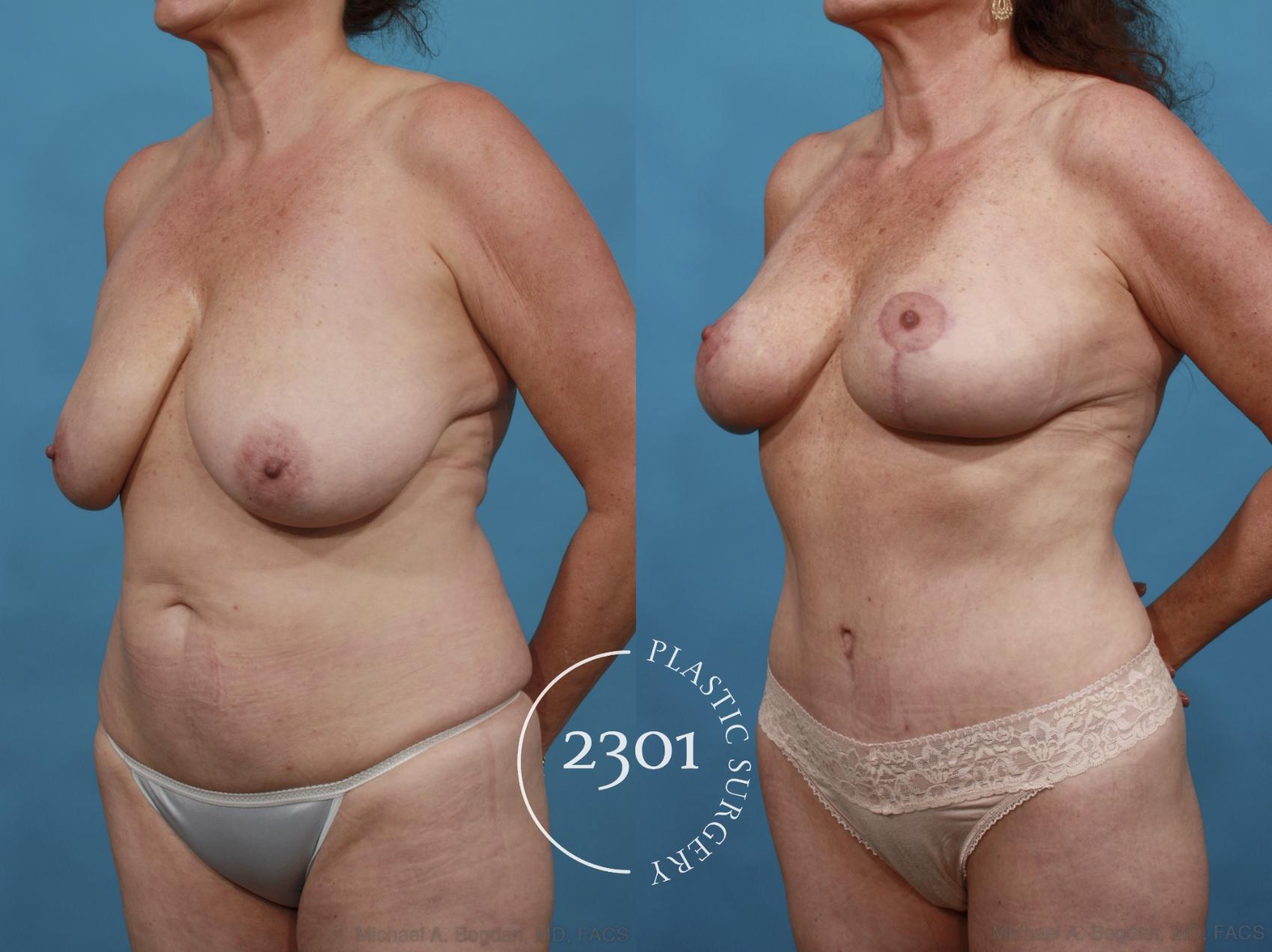 Before & After Tummy Tuck Case 542 View #2 View in Fort Worth, Plano, & Frisco, Texas