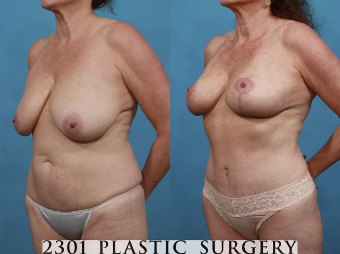 Before & After Tummy Tuck Case 542 View #2 View in Fort Worth, Plano, & Frisco, Texas