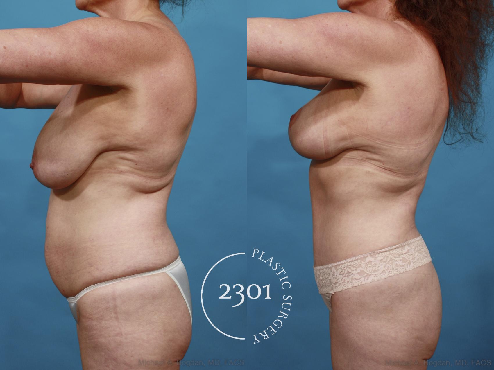 Before & After Tummy Tuck Case 542 View #3 View in Fort Worth, Plano, & Frisco, Texas