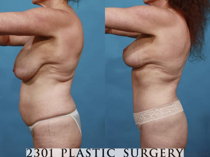 Before & After Tummy Tuck Case 542 View #3 View in Fort Worth, Plano, & Frisco, Texas