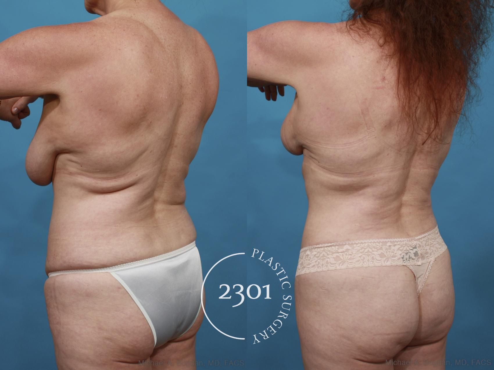 Before & After Tummy Tuck Case 542 View #4 View in Fort Worth, Plano, & Frisco, Texas