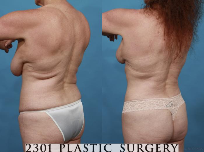 Before & After Tummy Tuck Case 542 View #4 View in Fort Worth, Plano, & Frisco, Texas