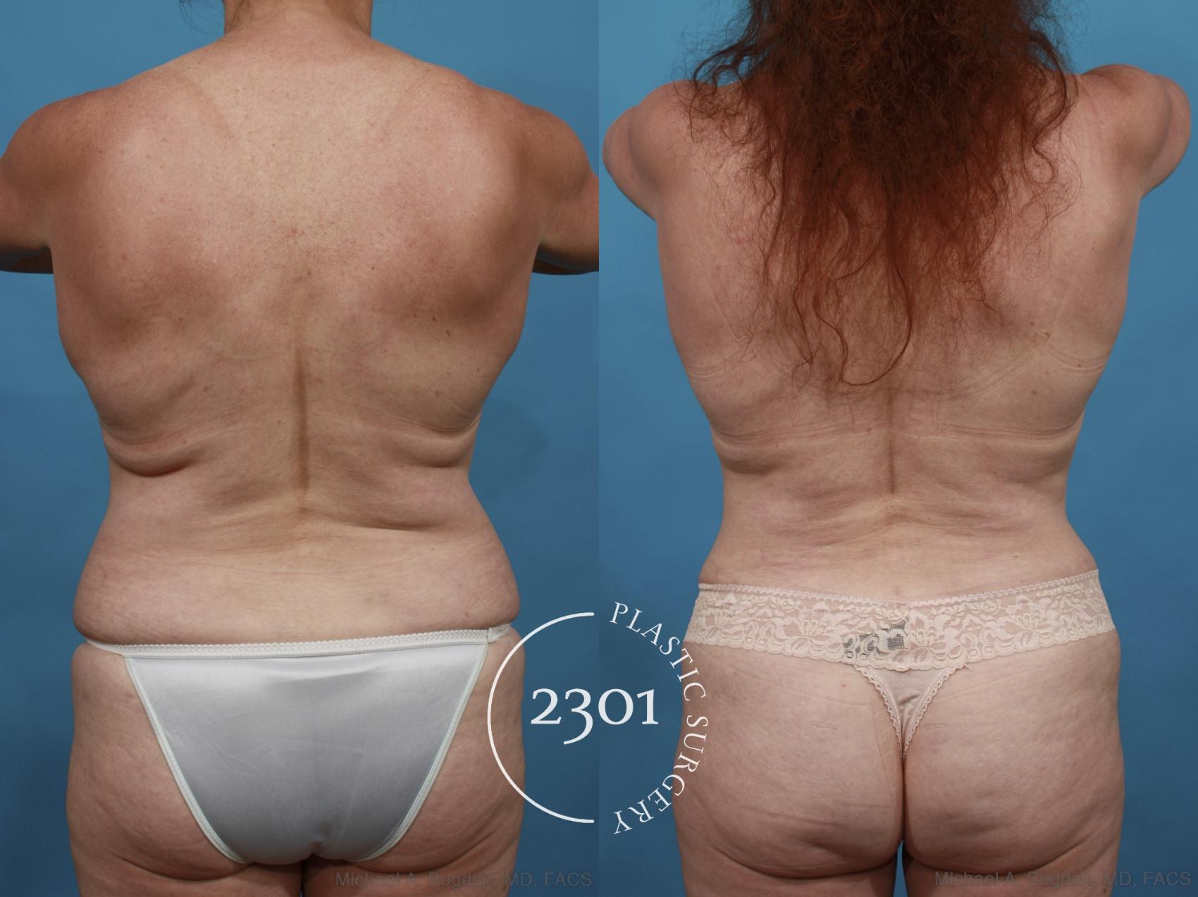 Before & After Tummy Tuck Case 542 View #5 View in Fort Worth, Plano, & Frisco, Texas