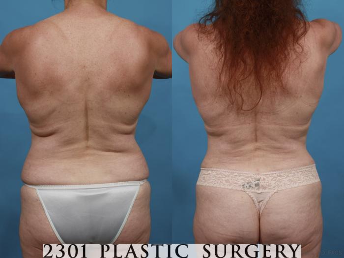 Before & After Tummy Tuck Case 542 View #5 View in Fort Worth, Plano, & Frisco, Texas