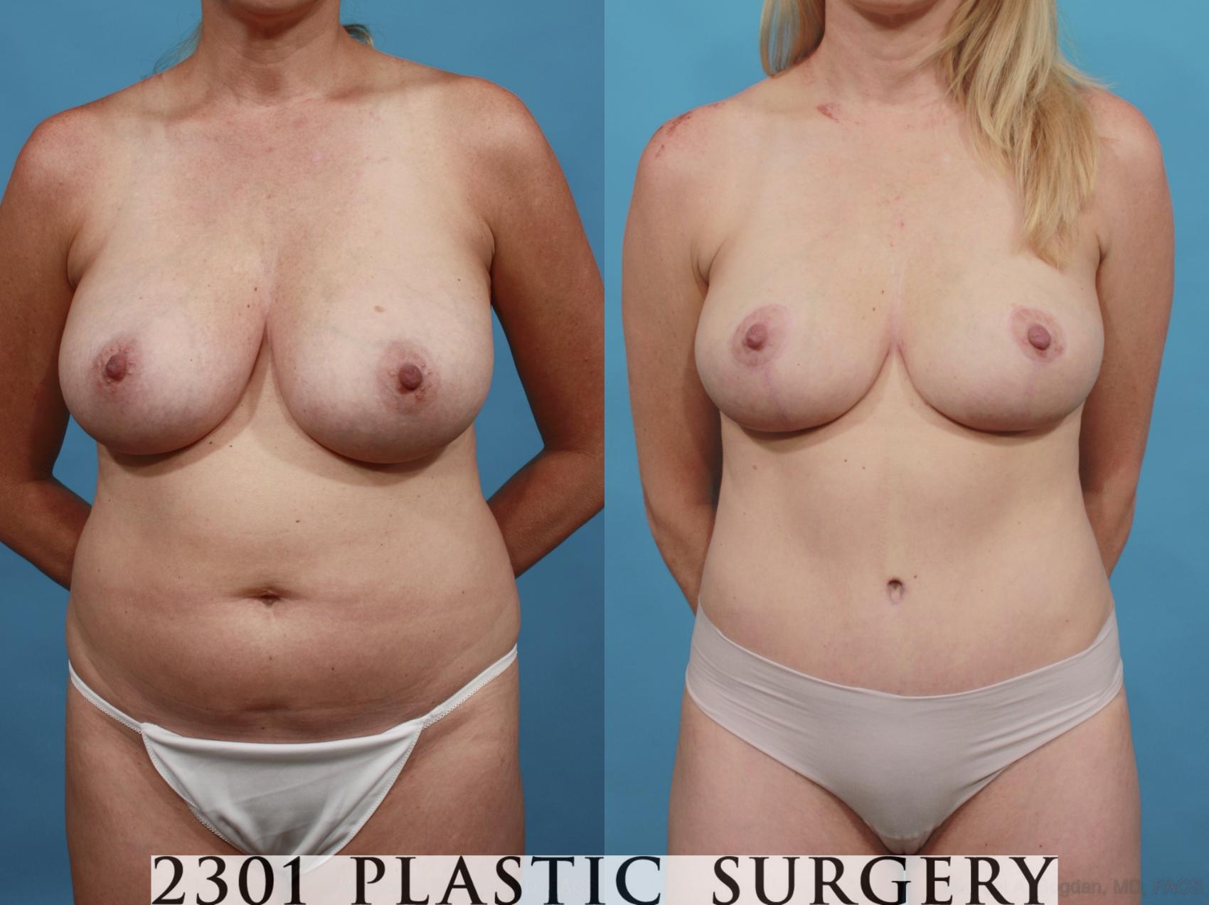 Before & After Mommy Makeover Case 547 View #1 View in Fort Worth & Frisco, Texas