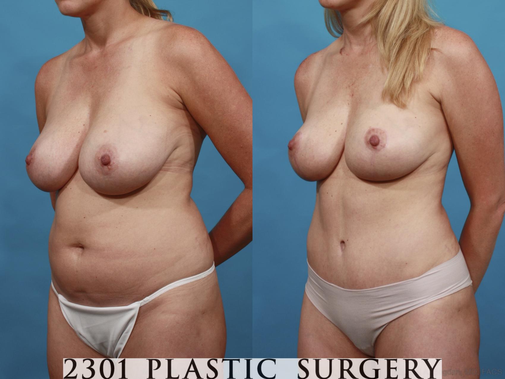 Before & After Mommy Makeover Case 547 View #2 View in Fort Worth & Frisco, Texas