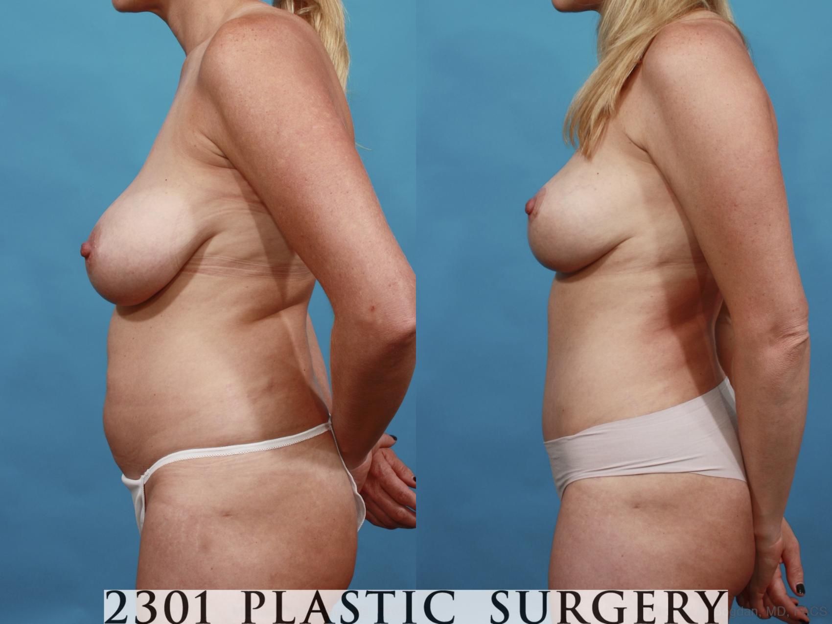 Before & After Mommy Makeover Case 547 View #3 View in Fort Worth & Frisco, Texas