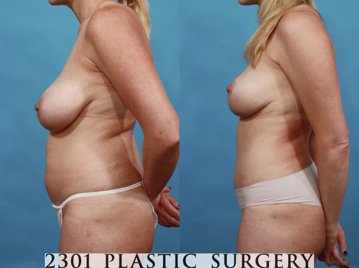 Before & After Mommy Makeover Case 547 View #3 View in Fort Worth, Plano, & Frisco, Texas