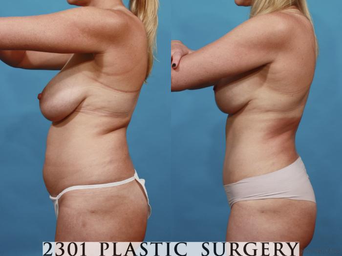 Before & After Mommy Makeover Case 547 View #4 View in Fort Worth, Plano, & Frisco, Texas