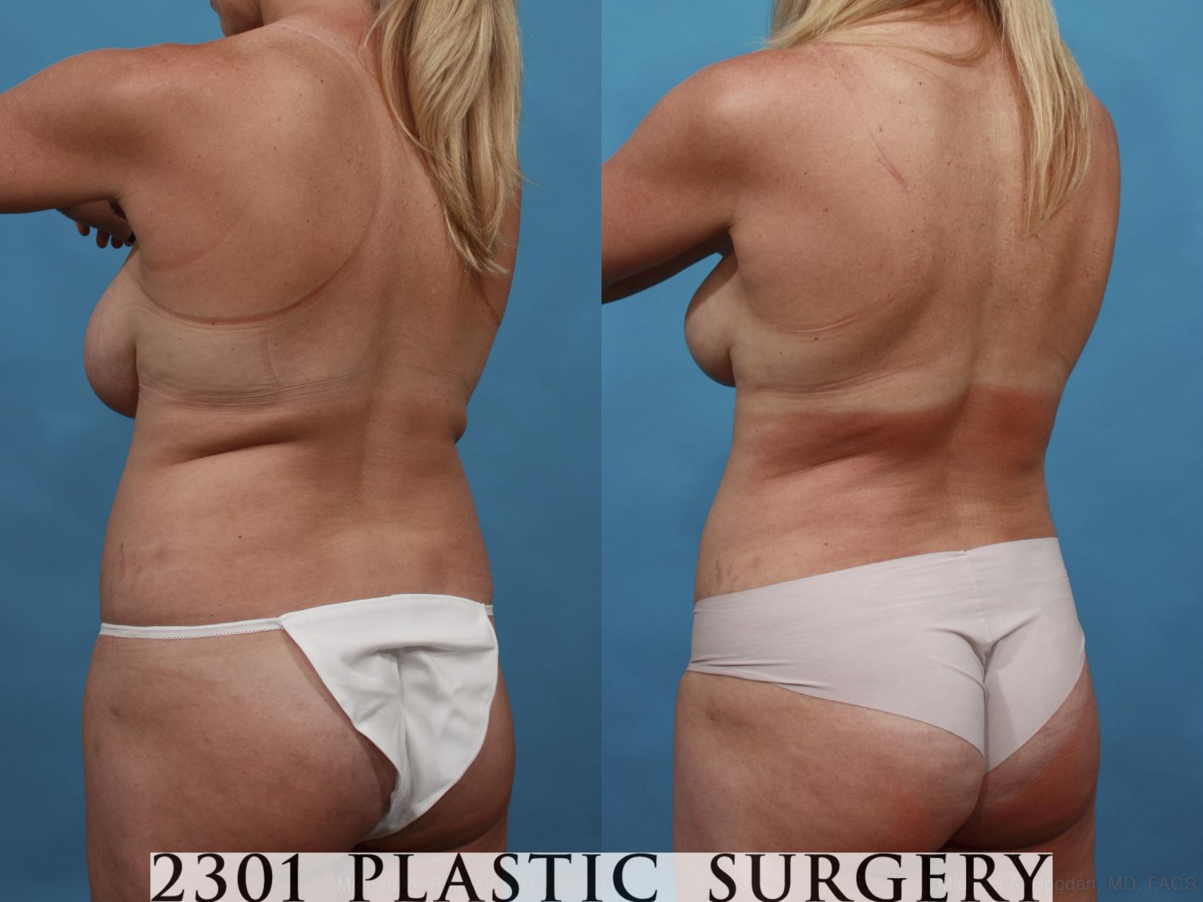 Before & After Mommy Makeover Case 547 View #5 View in Fort Worth & Frisco, Texas